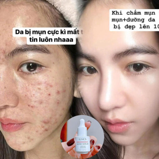 SERUM TRỊ MỤN LUMOS ACNE (MẪU MỚI) - Hình ảnh 2