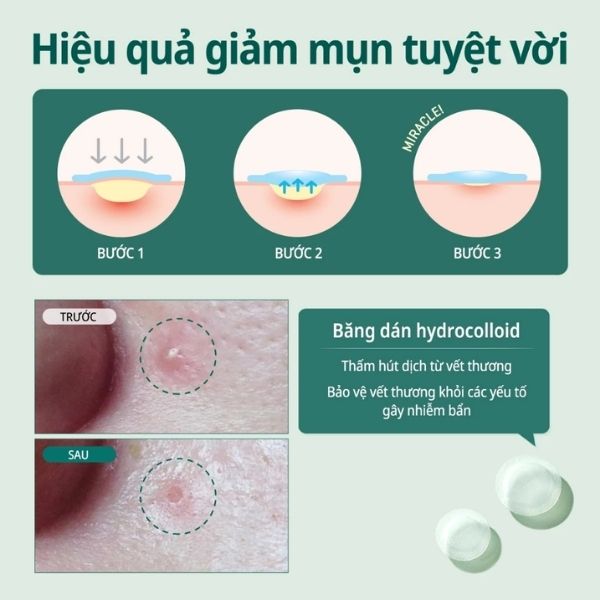 mieng-dan-tri-mun-some-by-mi-clear-spot-patch204 Miếng Dán Mụn Some By Mi Clear Spot Patch 18 PCS
